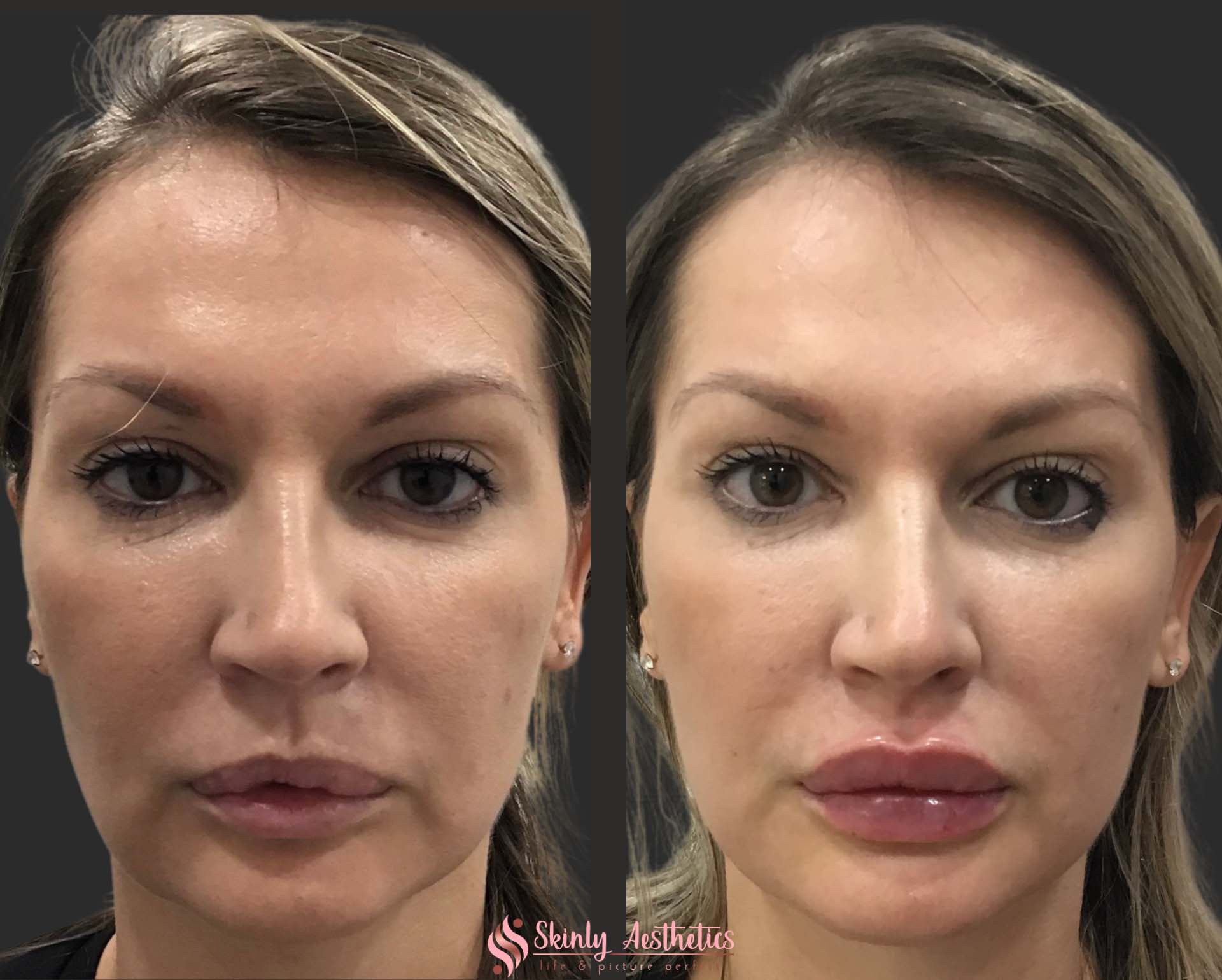 Russian style lip filler injection