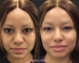Russian style lip filler injection