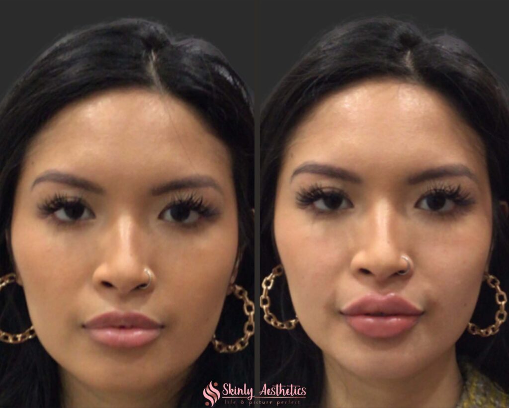 Russian technique lip augmentation before and after