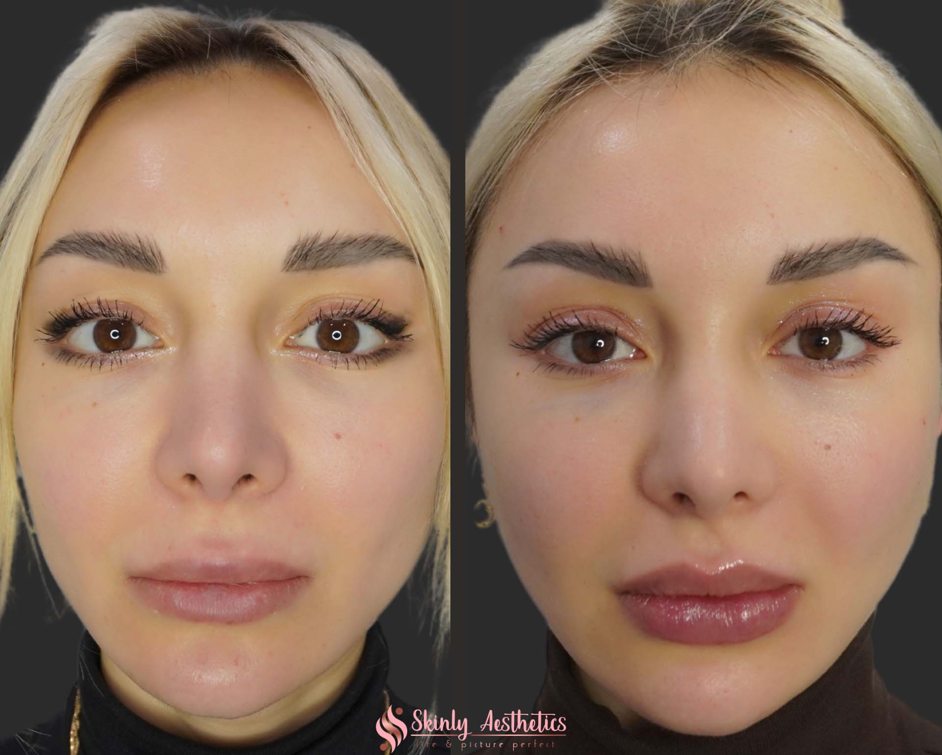 Russian technique lip filler injection before and after results