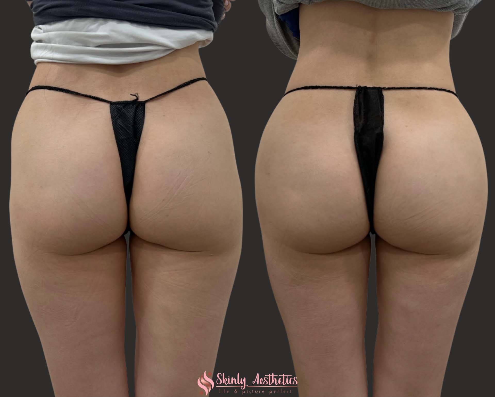 Sculptra bubble butt injections for hip dips