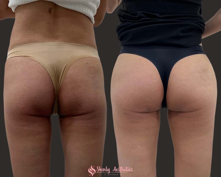 before and after results following Sculptra hip dips injections