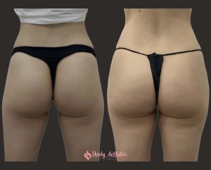 Sculptra filler hips results