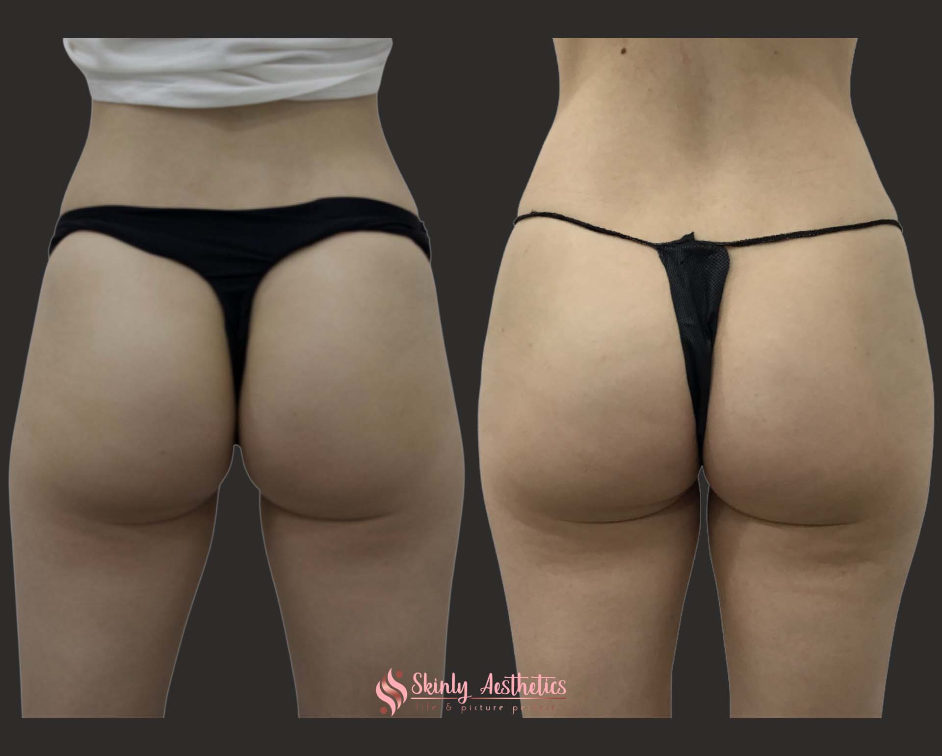 Sculptra hip dents before and after results