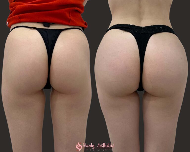 CherryBomb Aesthetics - 𝐁𝐔𝐓𝐓𝐎𝐂𝐊 𝐄𝐍𝐇𝐀𝐍𝐂𝐄𝐌𝐄𝐍𝐓 🍑 Before &  after our patients Buttock Enhancement/Hip Dip Filler. We created this look  using 100ml of filler. We're proud to be the only clinic in