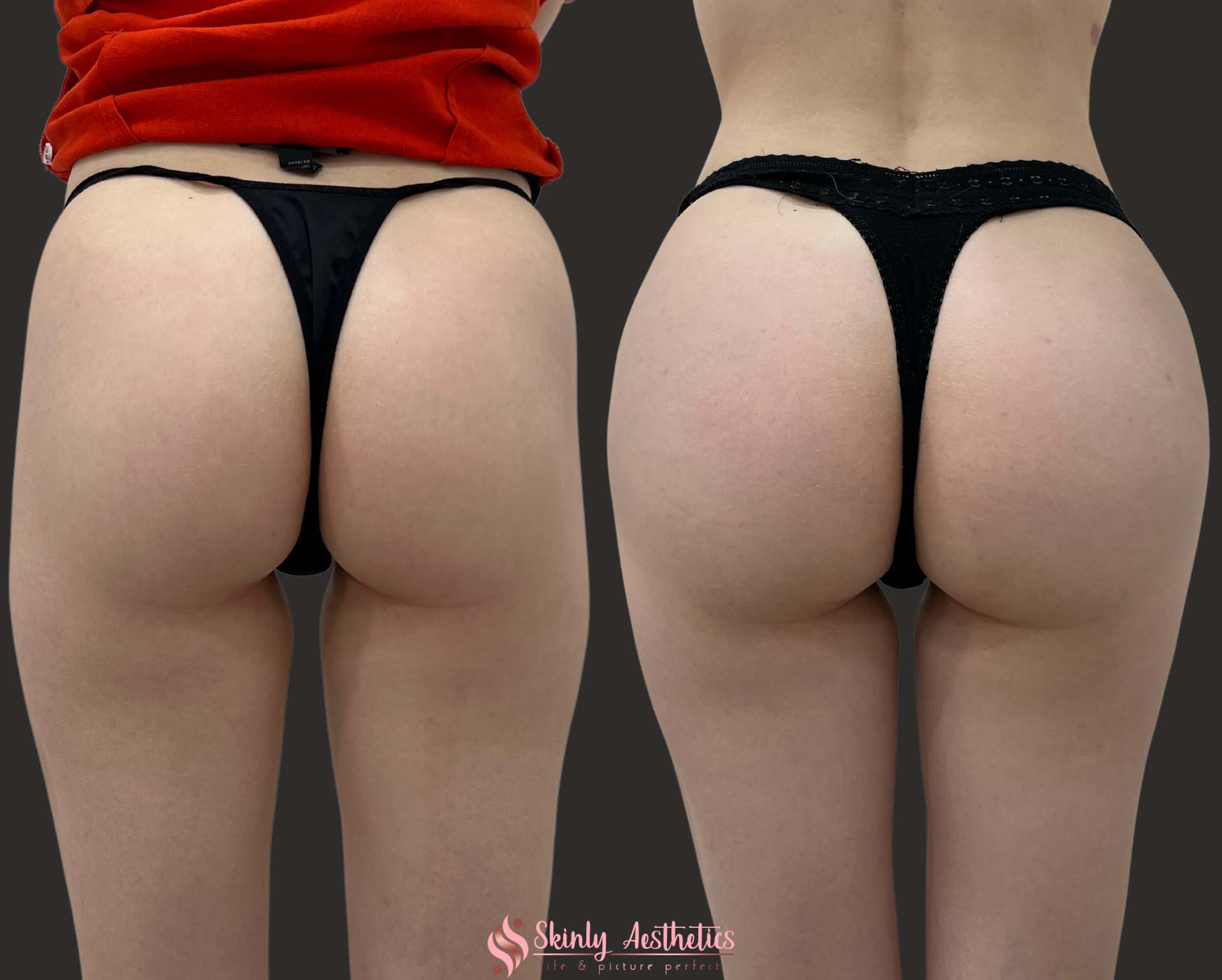 before and after results following multiple sessions of Sculptra injections for hip dips corrections