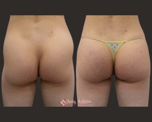 Sculptra hip dips treatment