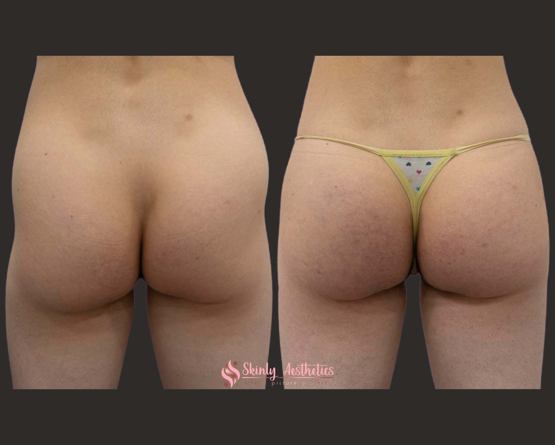 before and after results following treatment of severe hip dip dents with Sculptra filler