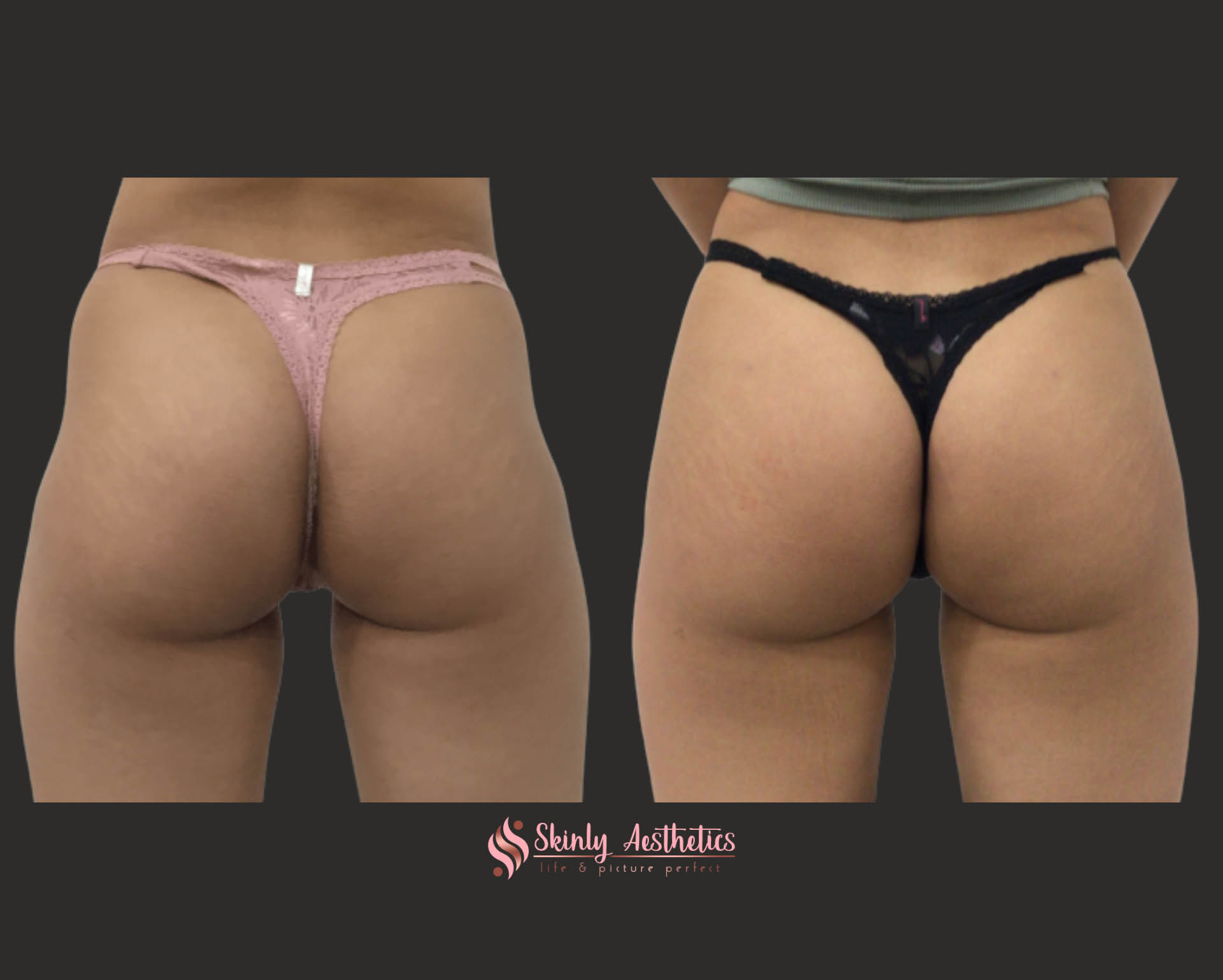 before and after butt lift results following 4 vials of Sculptra filler injections