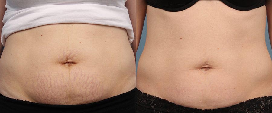 before and after results of treating stretch marks with Ultherapy