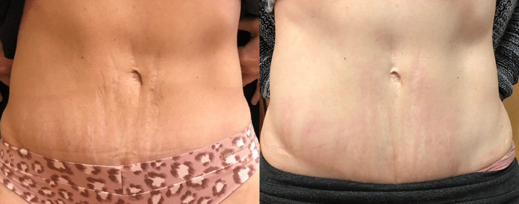 before and after results of treating abdominal stretch marks with fractional laser technology