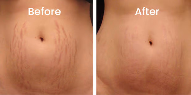 before and after results of treating stretch marks with microneedling