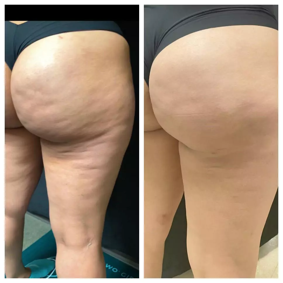 Cellulite Treatment