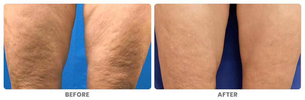 Before and after results radiofrequency microneedling for cellulite on legs