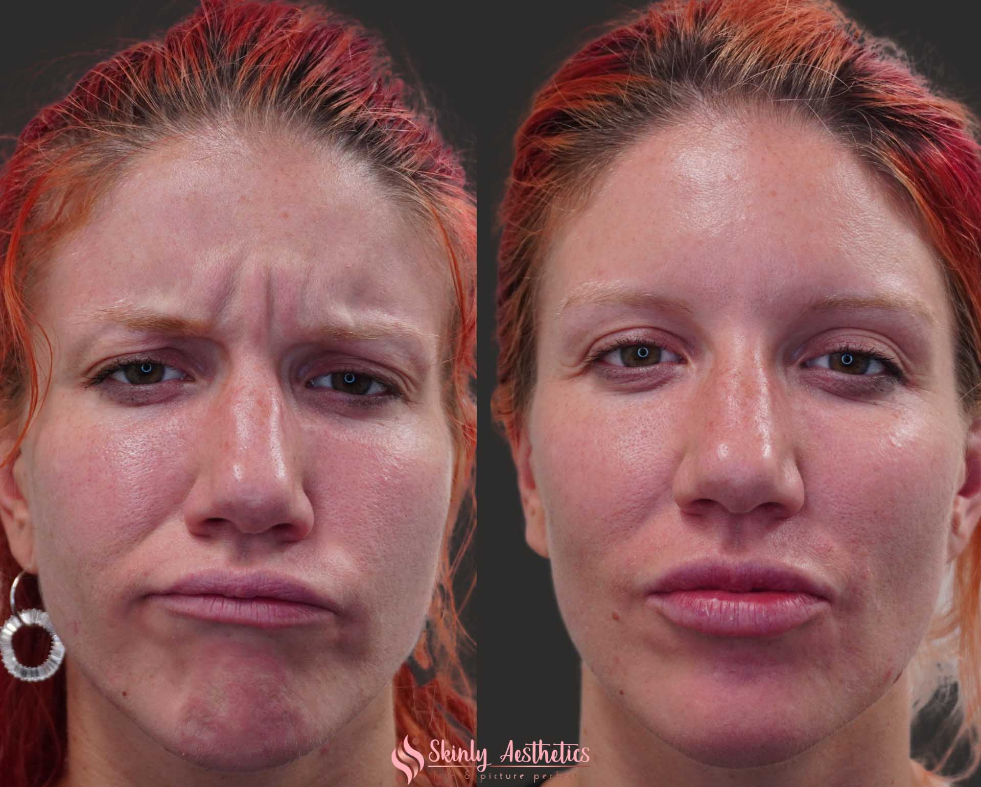 botox 11s lines before and after results