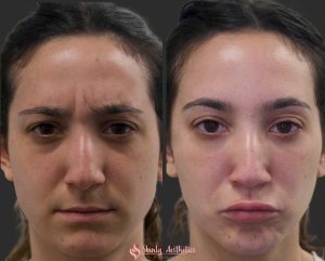 botox 11s wrinkles