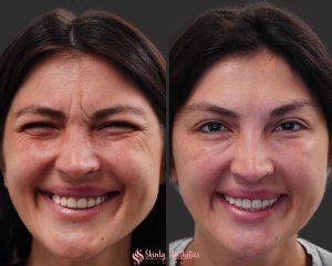 botox crows feet