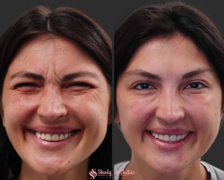 before and after results following Botox crows feet injections