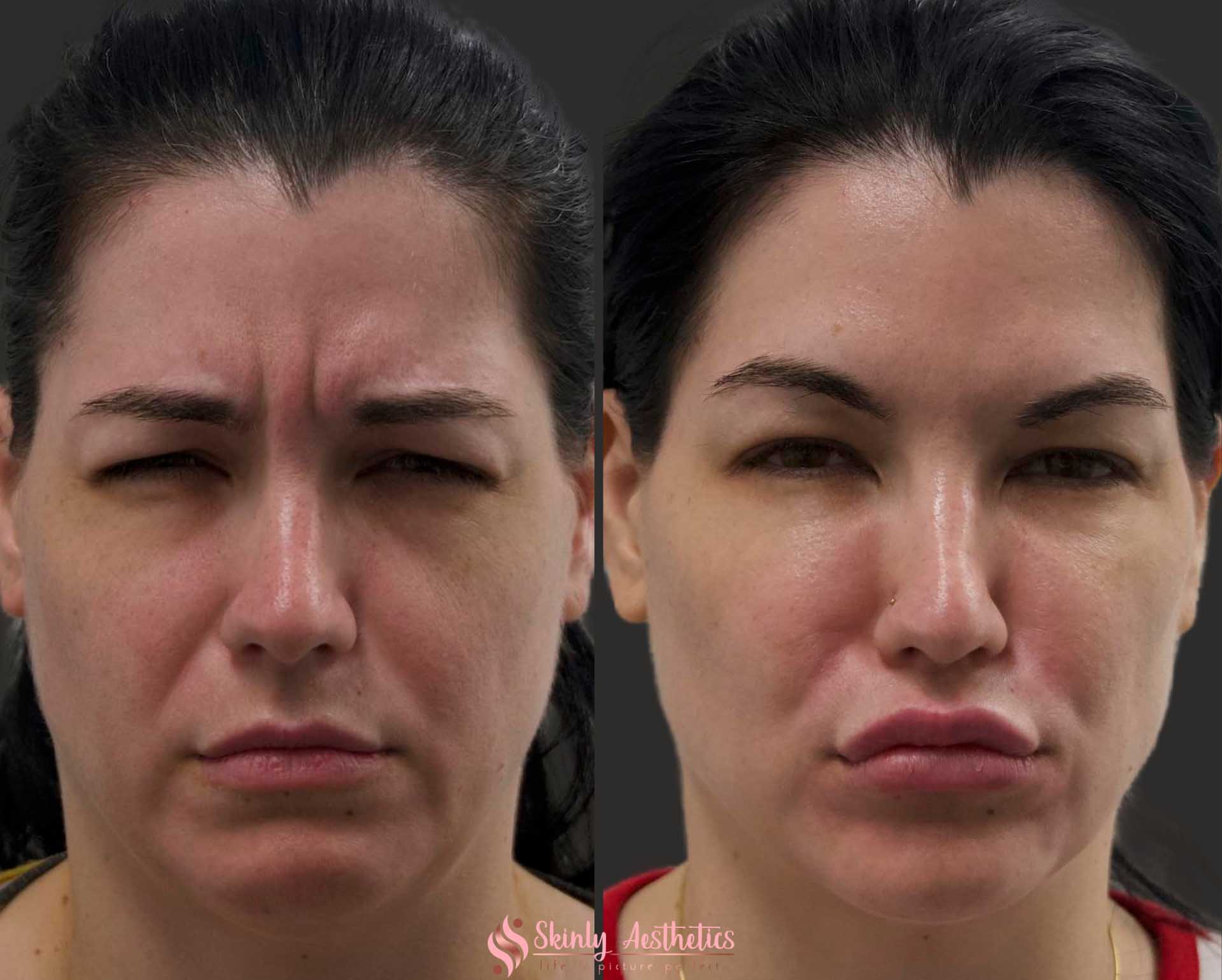 before and after results of botox glabella injections for frown lines