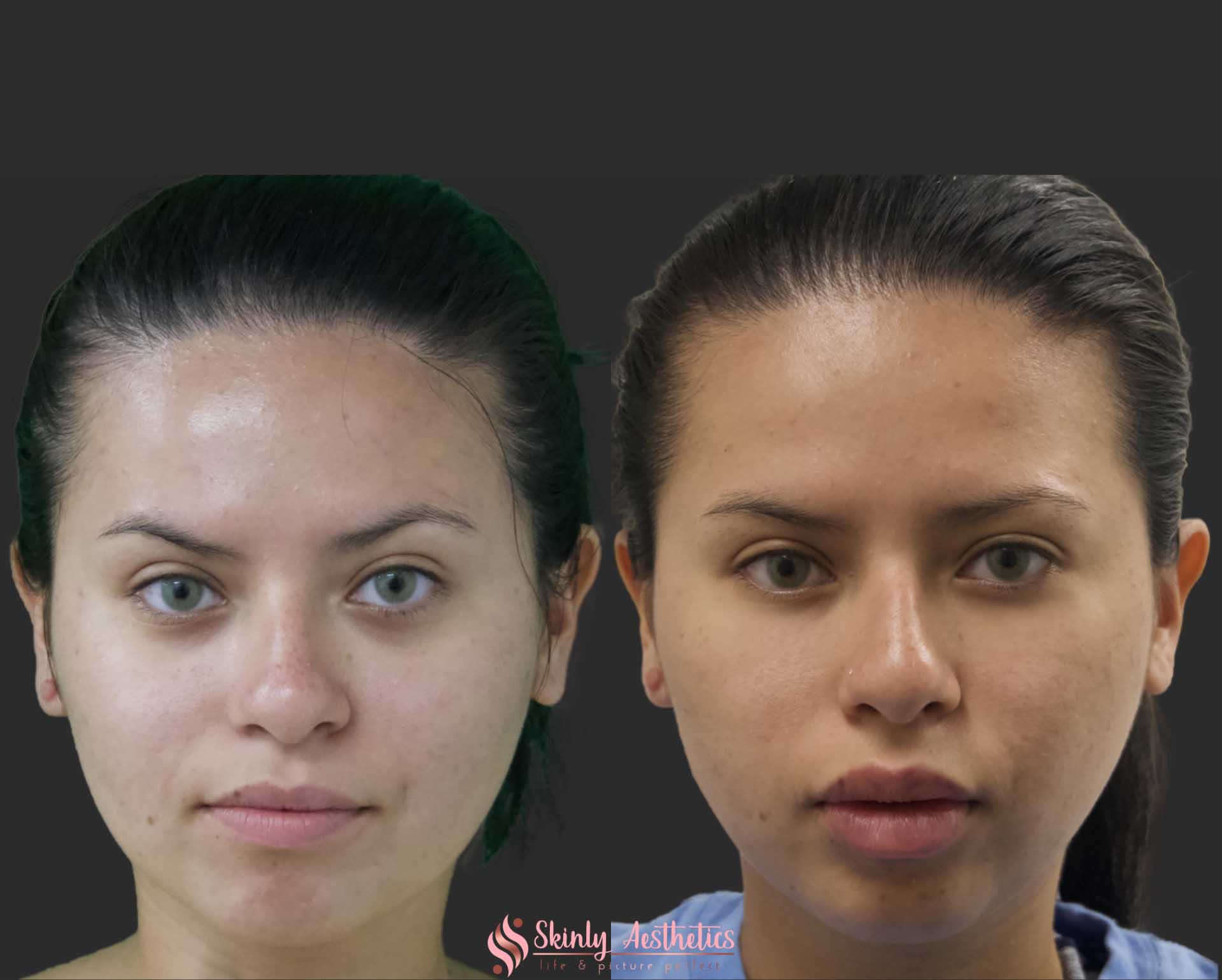 before and after botox jaw reduction