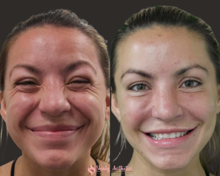 botox crows feet before and after results