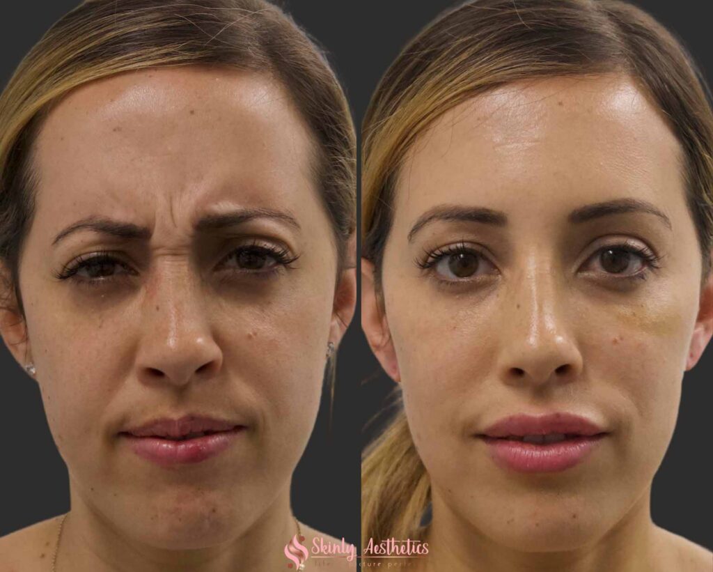 results after botox treatment for frown lines between eyebrows