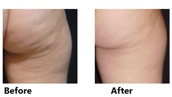 before and after results of acoustic wave therapy for cellulite on bottom