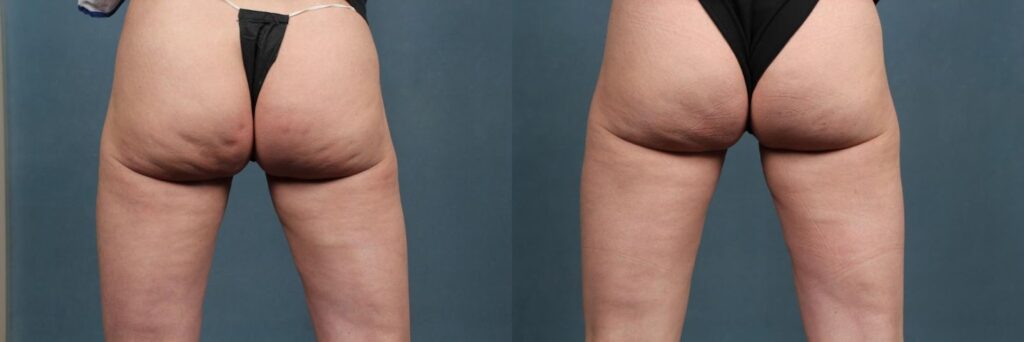 before and after results of Fraxel lasers on butt cellulite