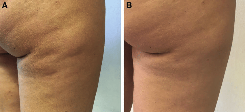 before and after results of subcision procedure for cellulite on legs and buttocks