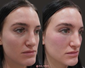 cheek augmentation and under eye bag treatment