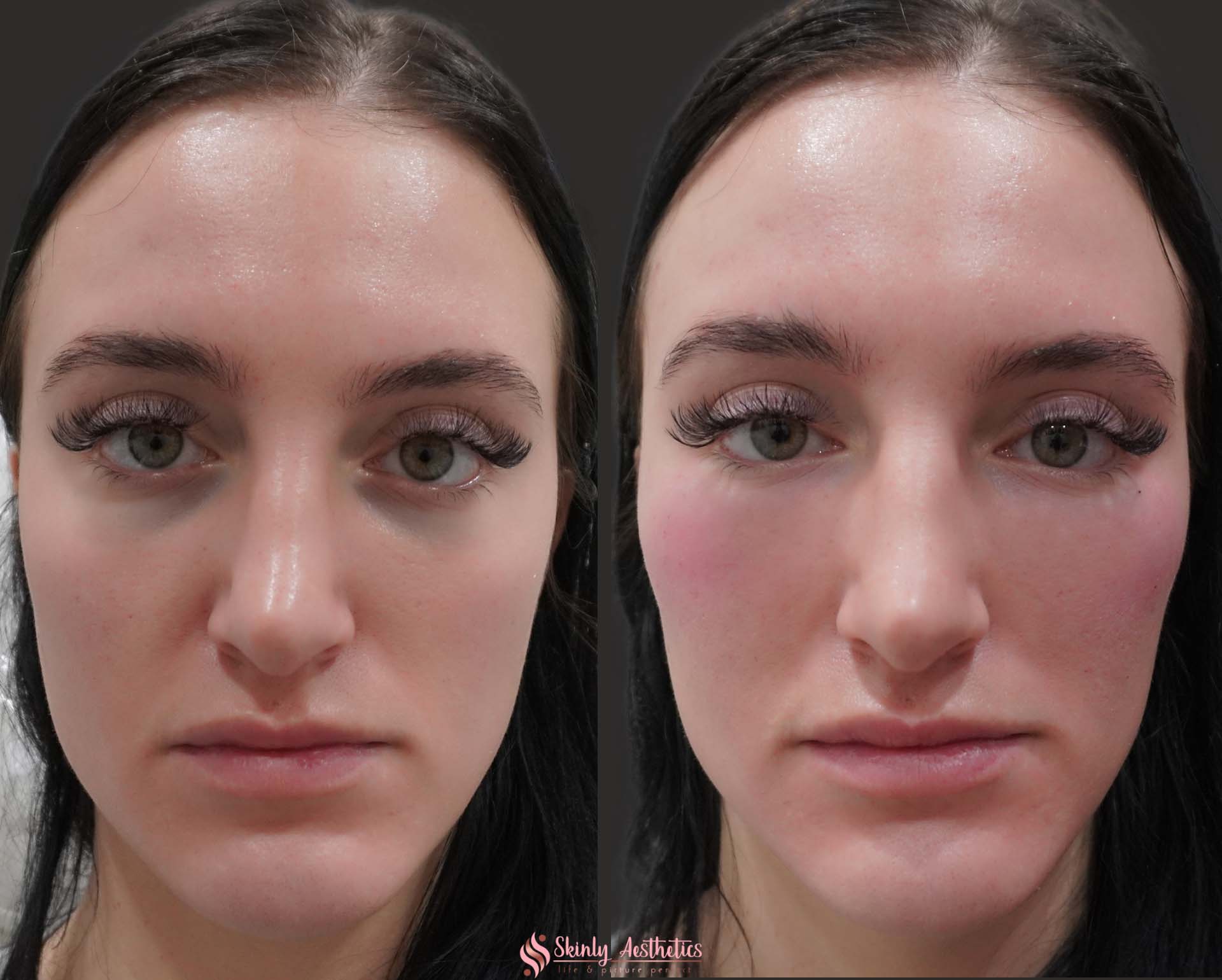 Non Surgical Cosmetic Procedures To Treat Dark Circles Hollows And