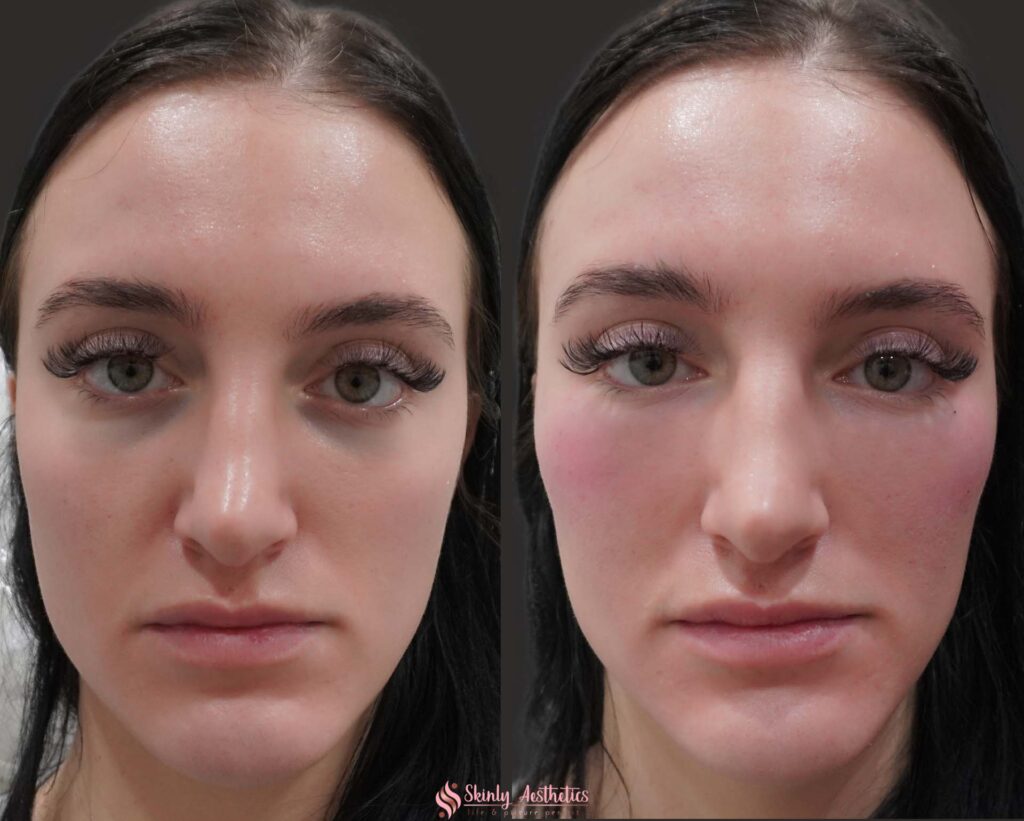 results after cheekbone augmentation and under eye dark circles treatment with Juvederm filler