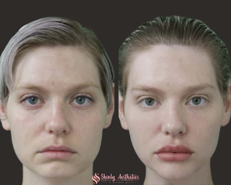 before and after results following cheek augmentation with Juvederm Voluma