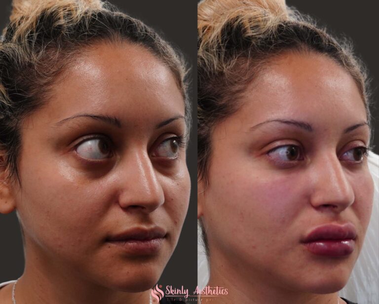 results after cheeks augmentation with Juvederm filler