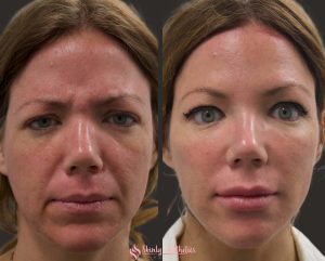 cheek filler augmentation with juvederm voluma