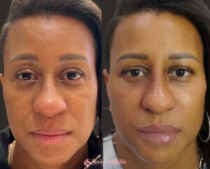 before and after results following cheek filler injection to lift sagging skin