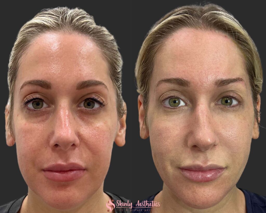 before and after cheek filler injection with Juvederm Voluma