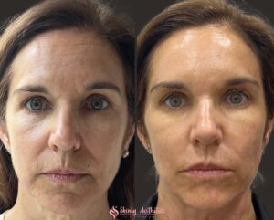 before and after cheekbone augmentation with Juvederm Voluma dermal filler