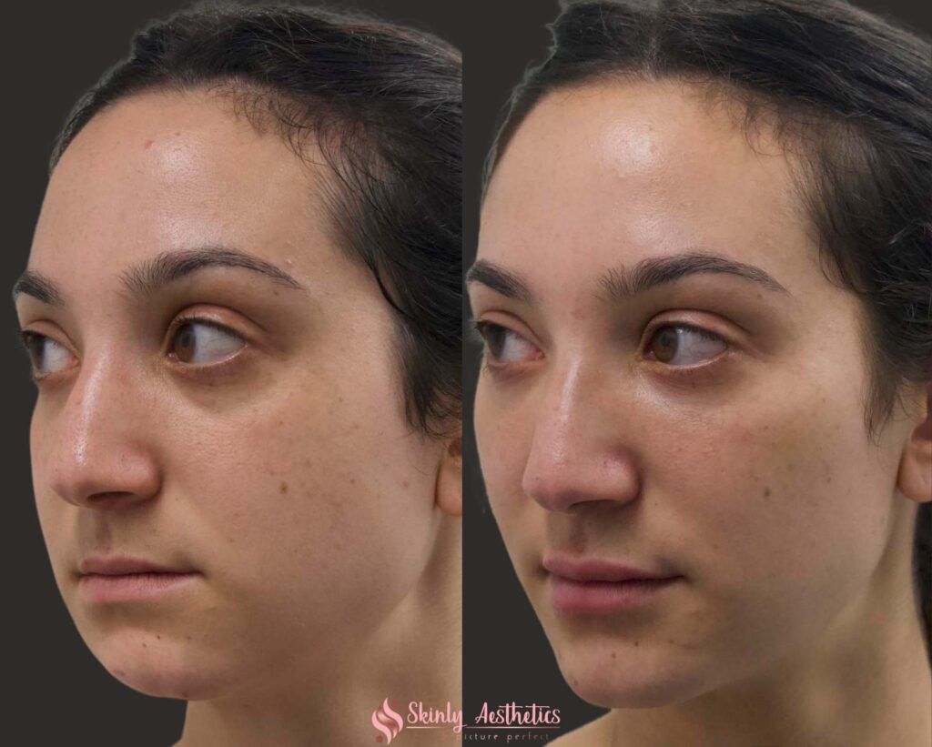 Juvederm filler chin augmentation before and after results