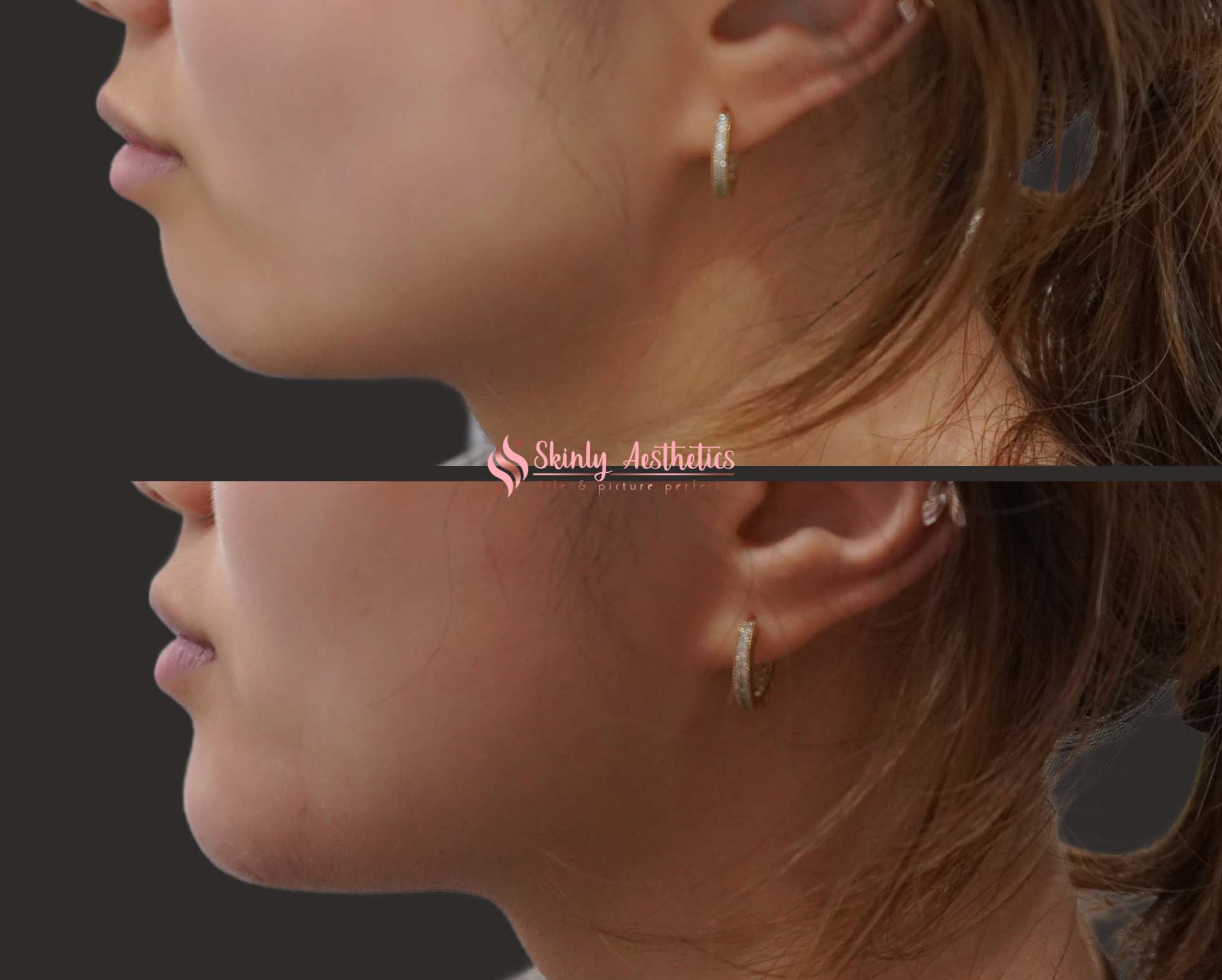 before and after results showing chin extension, elongation and augmentation with Juvederm Voluma hyaluronic acid filler