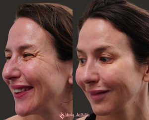 crows feet reduction with botox
