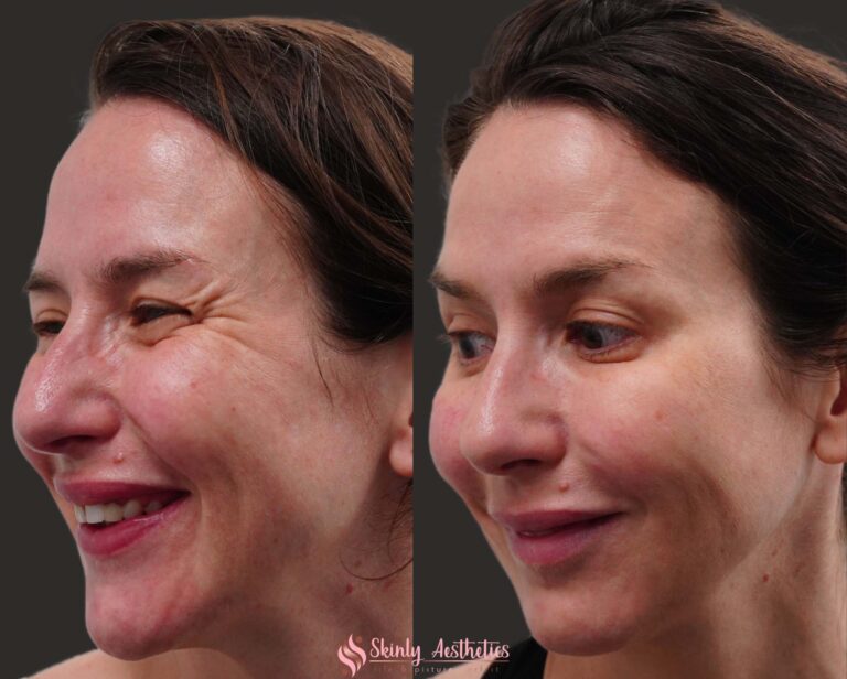 before and after results of botox crows feet reduction