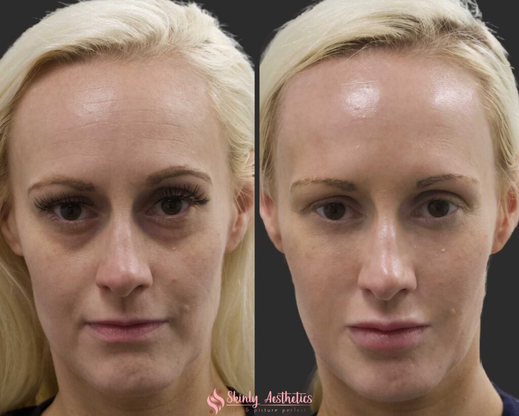 before and after under eye dark circles treatment with Juvederm filler
