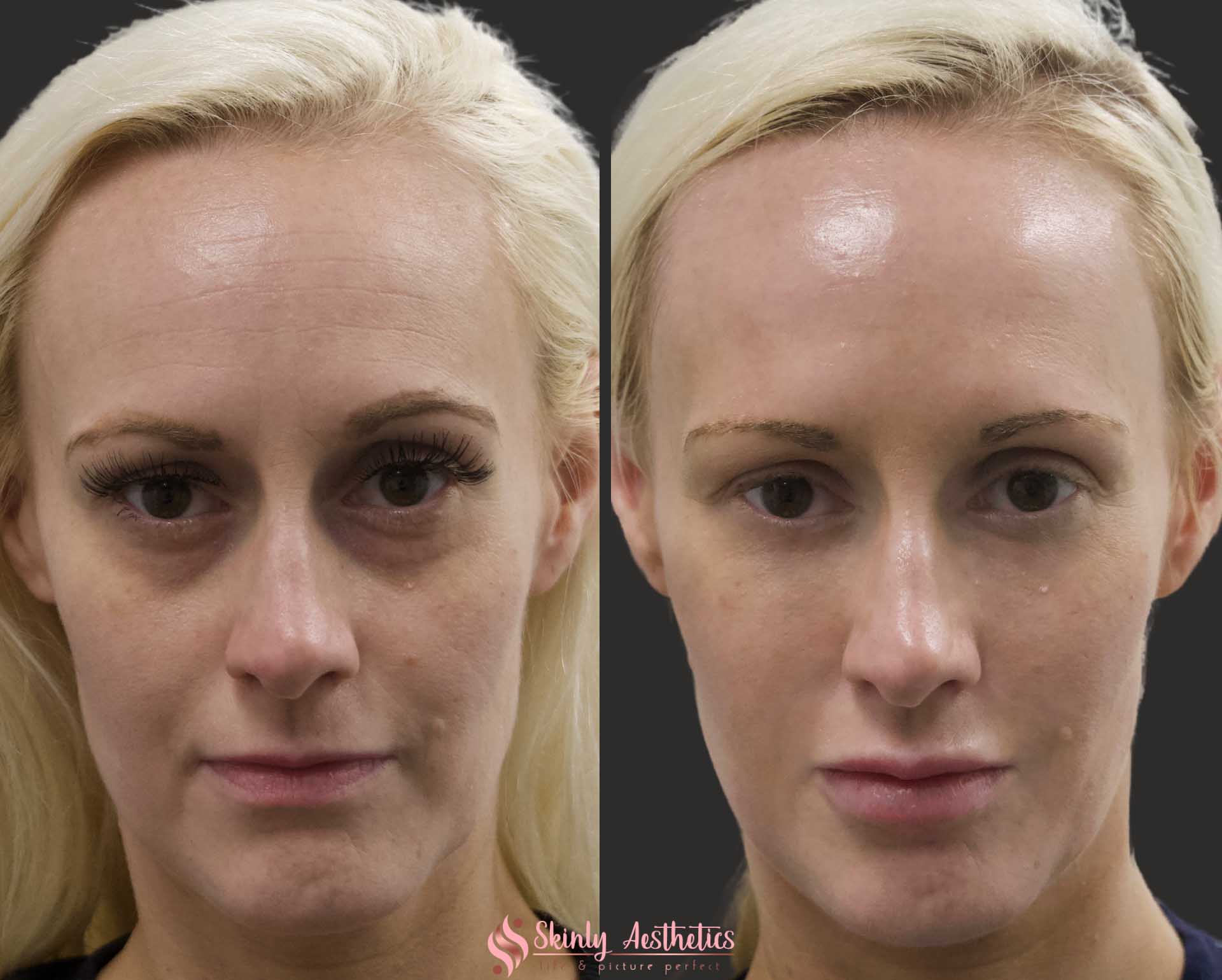 Under Eye Fillers Before After Results At Skinly