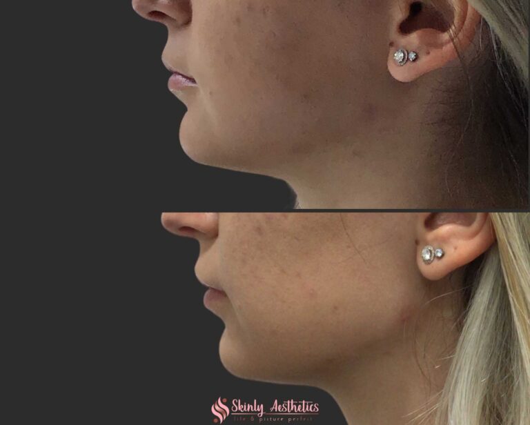 jawline shaping with dermal fillers