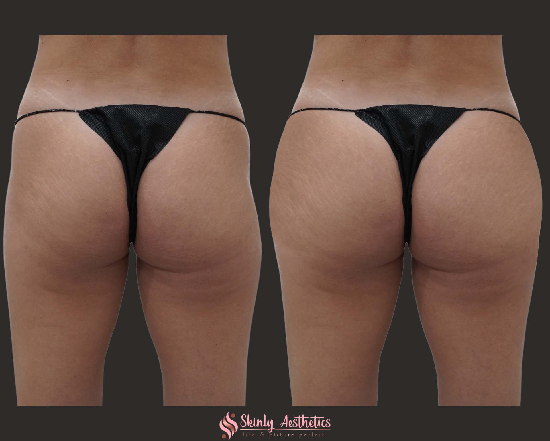 Sculptra treatment results following the filling of hip dips with fillers