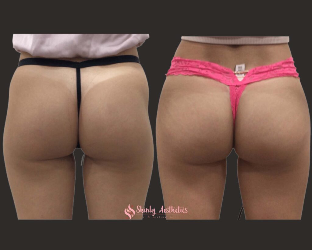 hip dip filler before and after results