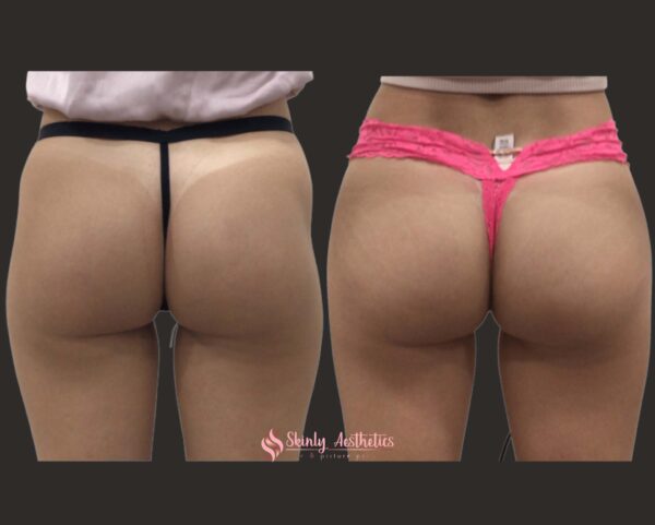before and after results following hip dip fillers
