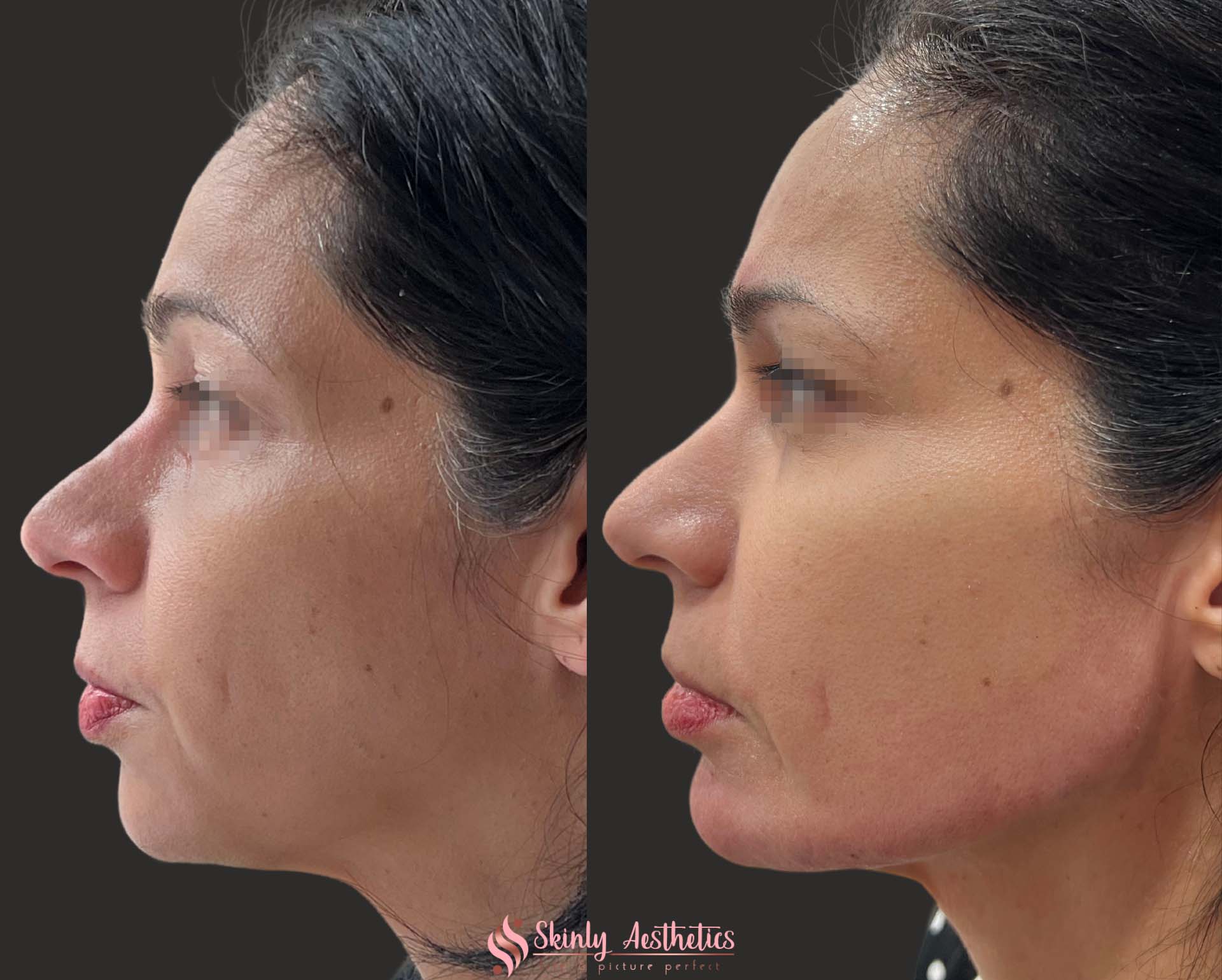before and after results following jawline and chin augmentation with Radiesse and Juvederm Voluma dermal fillers