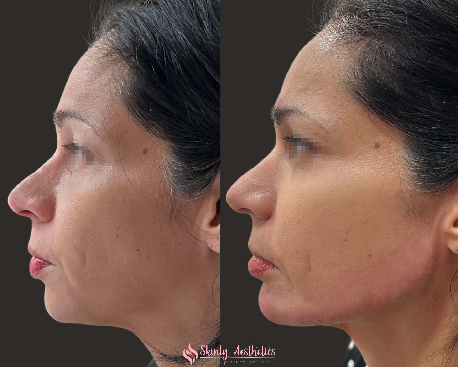 Jawline Fillers - Before & After Results at Skinly